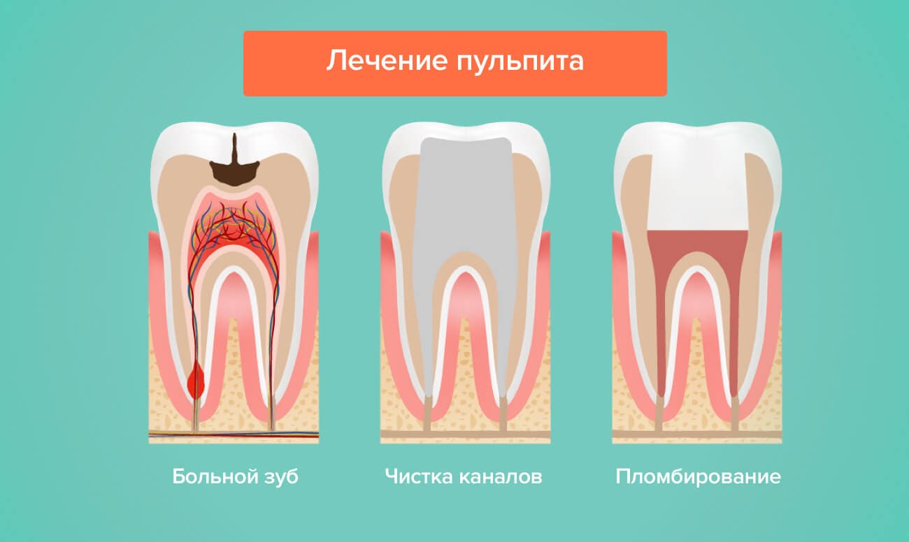 Лечение пульпита и каналов