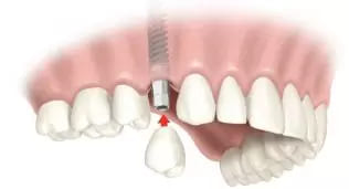 восстановление зуба на импланте